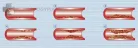 Érszűkűlet mérő - Rossmax sb200 arterosclerosis meghatározó  pulzoximéter